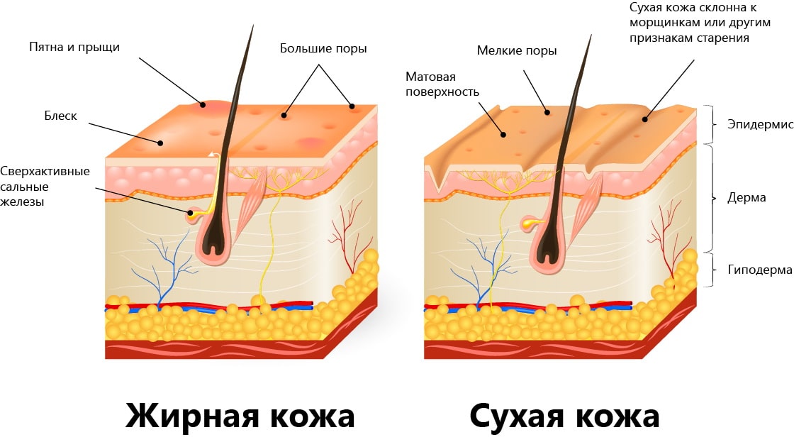 Сухая и жирная кожа