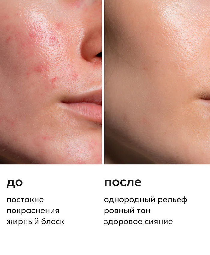 Likato Professional Post Acne Крем для лица 50 мл